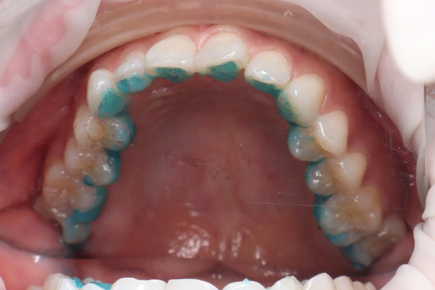 Xoi mòn mặt lưỡi của răng trước khi gắn mắc cài