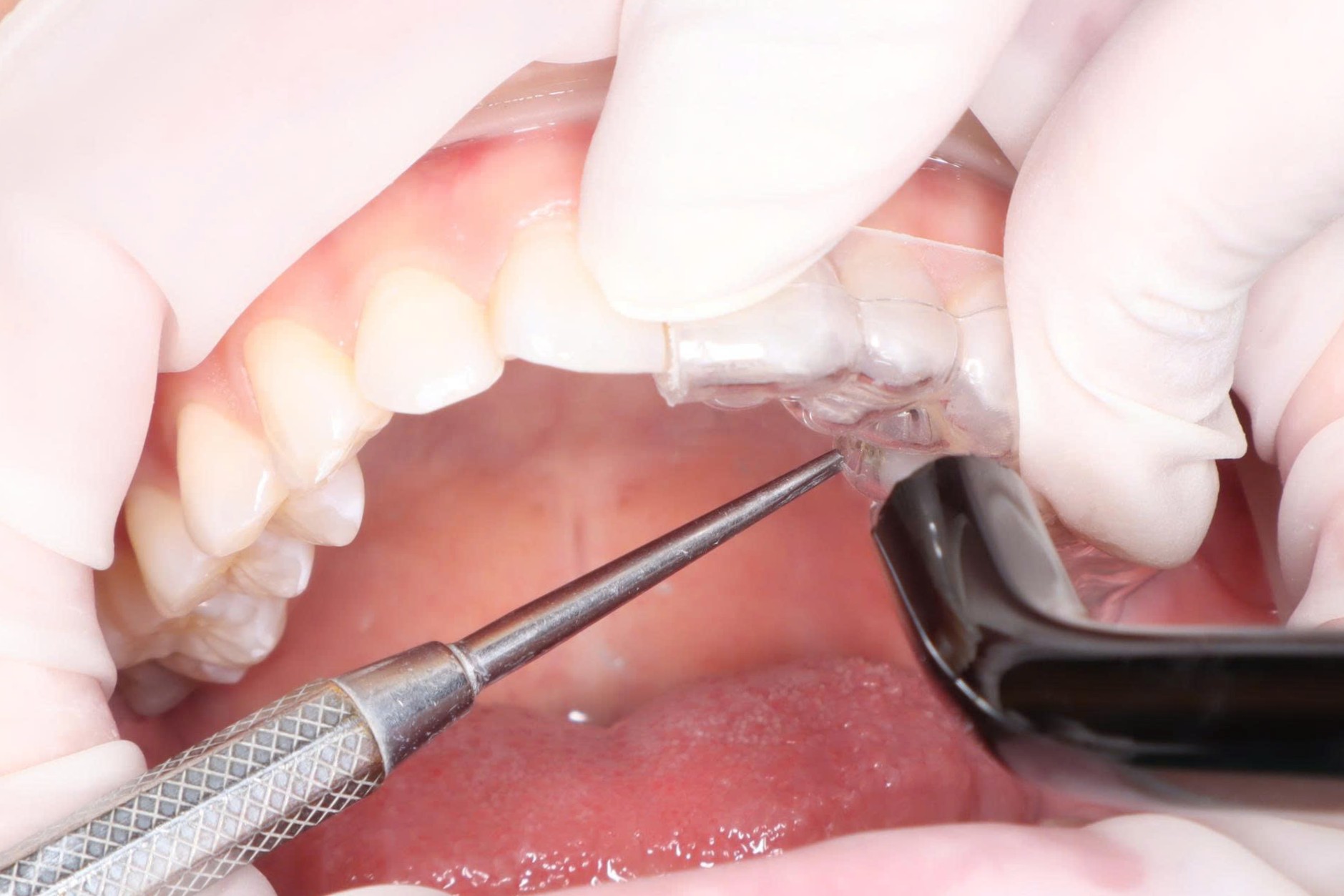 Đặt và ấn khít mảnh khay gắn gián tiếp trên răng