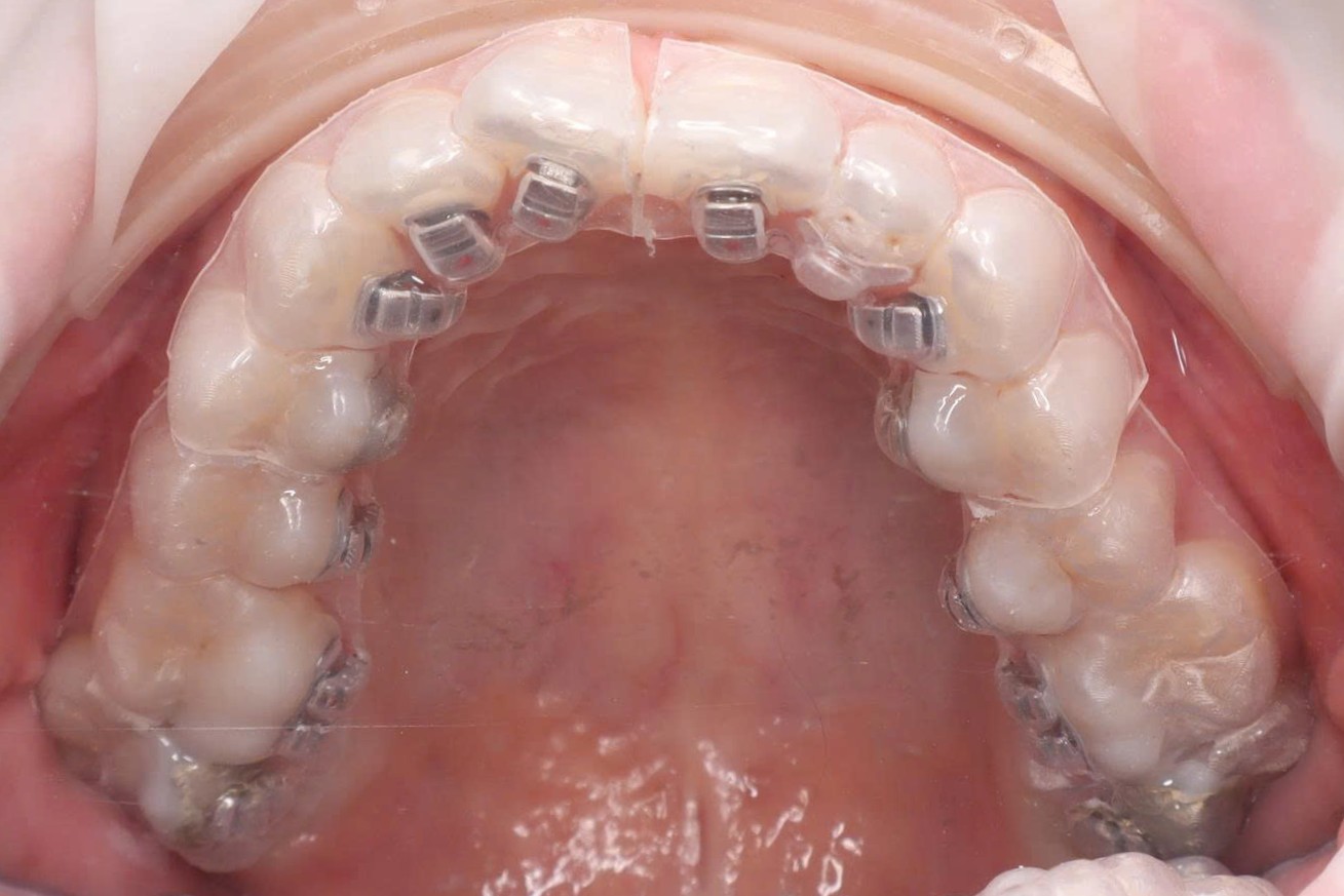Các phân đoạn khay hai lớp đã được đặt trên toàn bộ cung răng