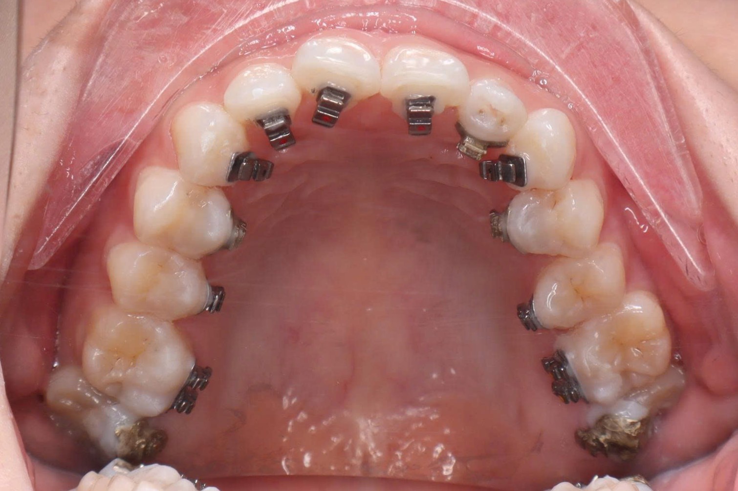 Mắc cài mặt lưỡi sau khi tháo lớp cứng và lớp mềm của khay